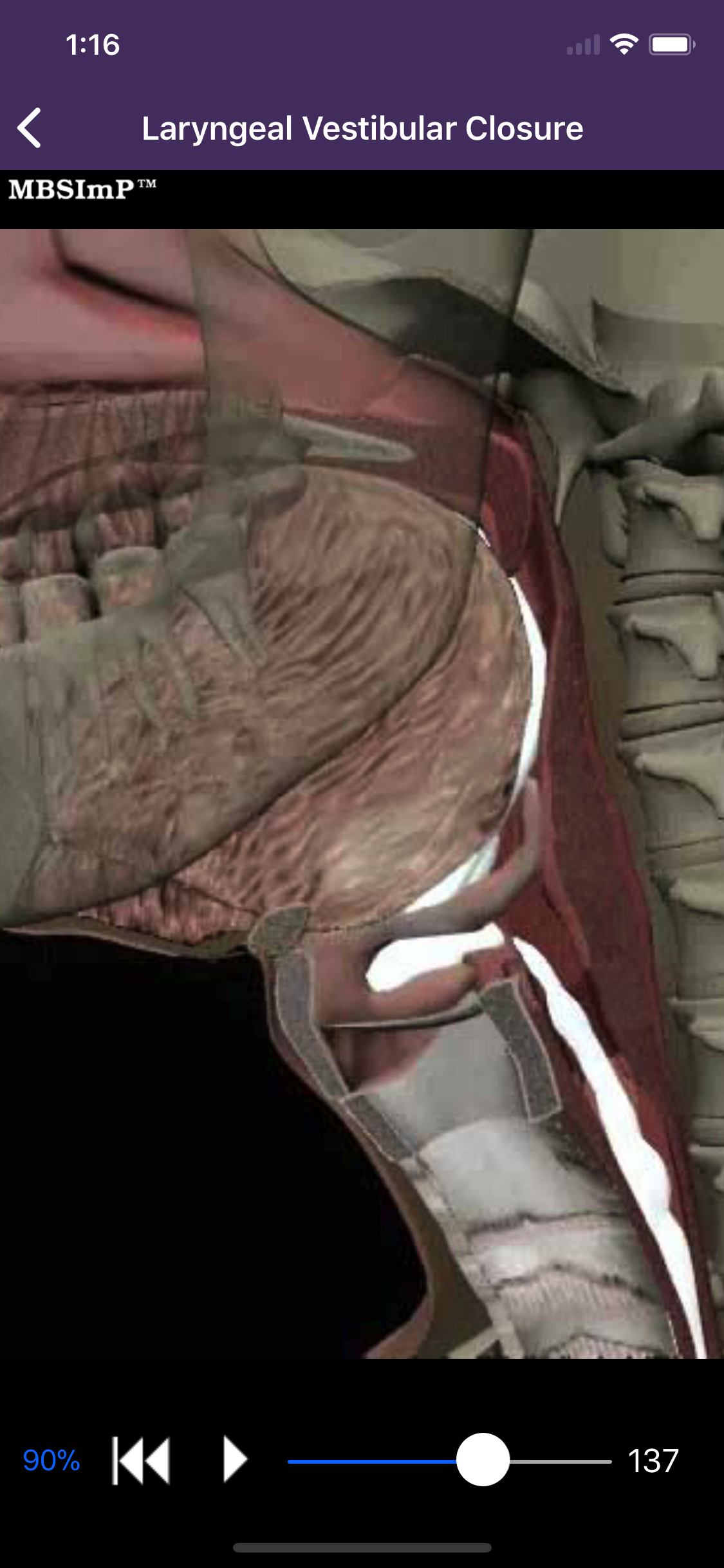 Dysphagia