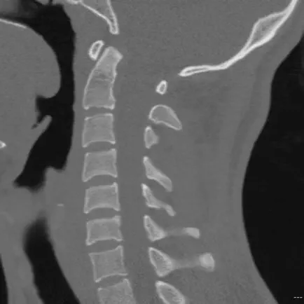 CT Cervical Spine Cheats