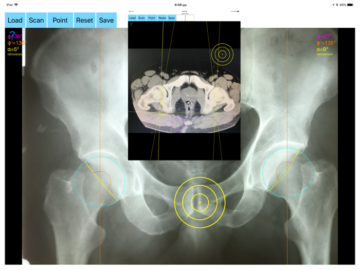 AcetabularAnteversionApp