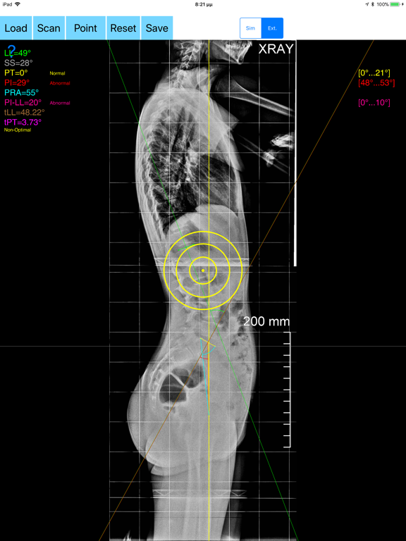 SpinopelvicBalanceApp iPad screenshot