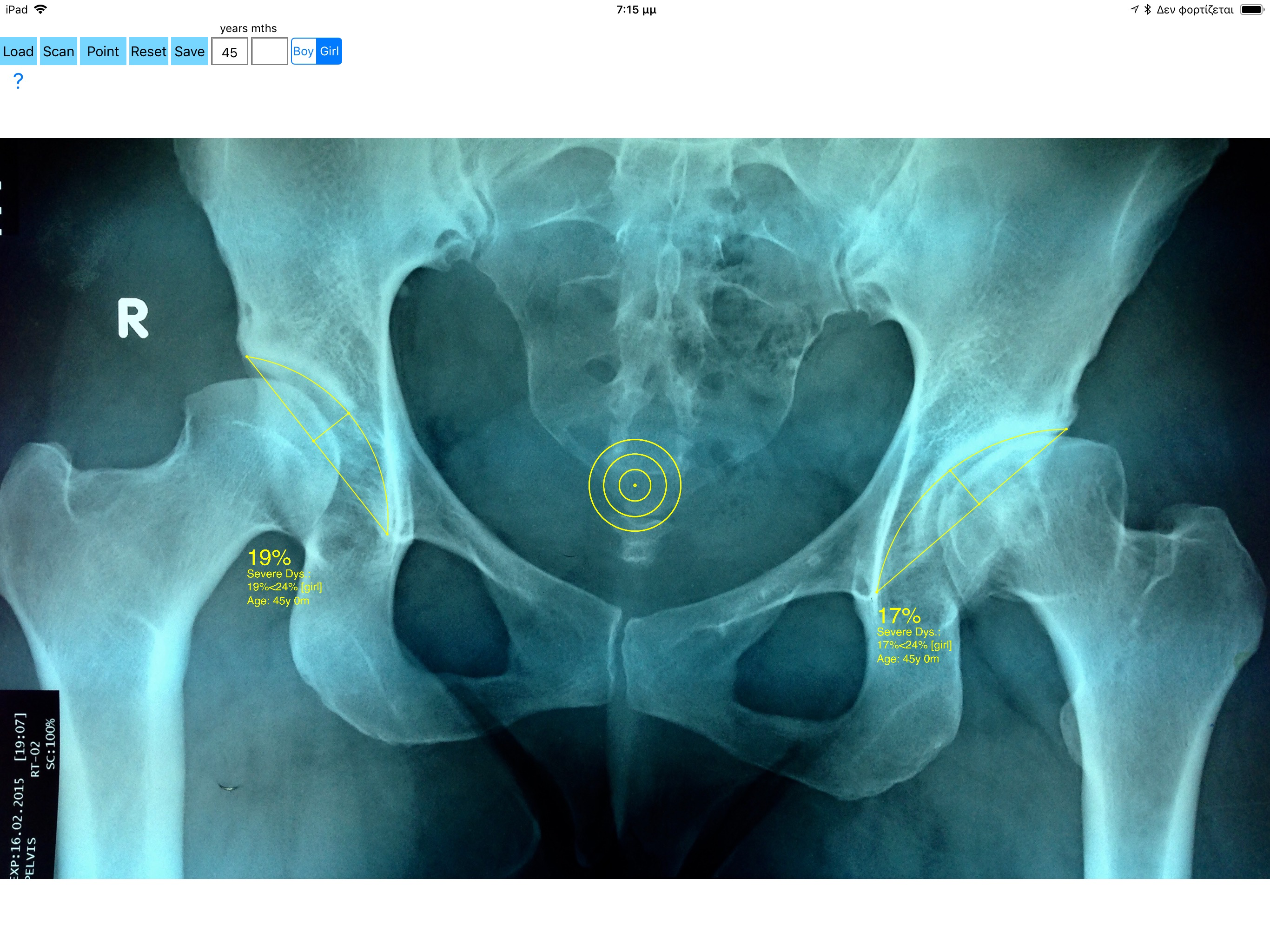 AcetabularDepthRatioApp screenshot 16