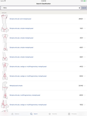 AO/OTA Fracture Classificationのおすすめ画像3