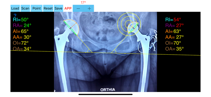 CupAnteversionInclinationApp