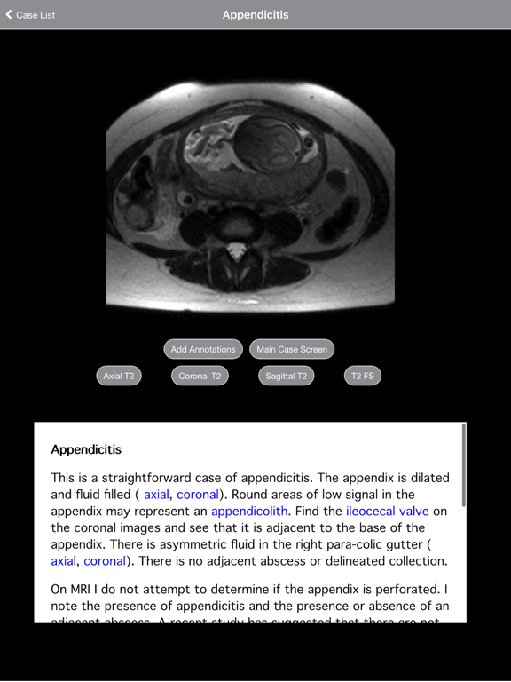 Screenshot #6 pour Pregnant Appendicitis