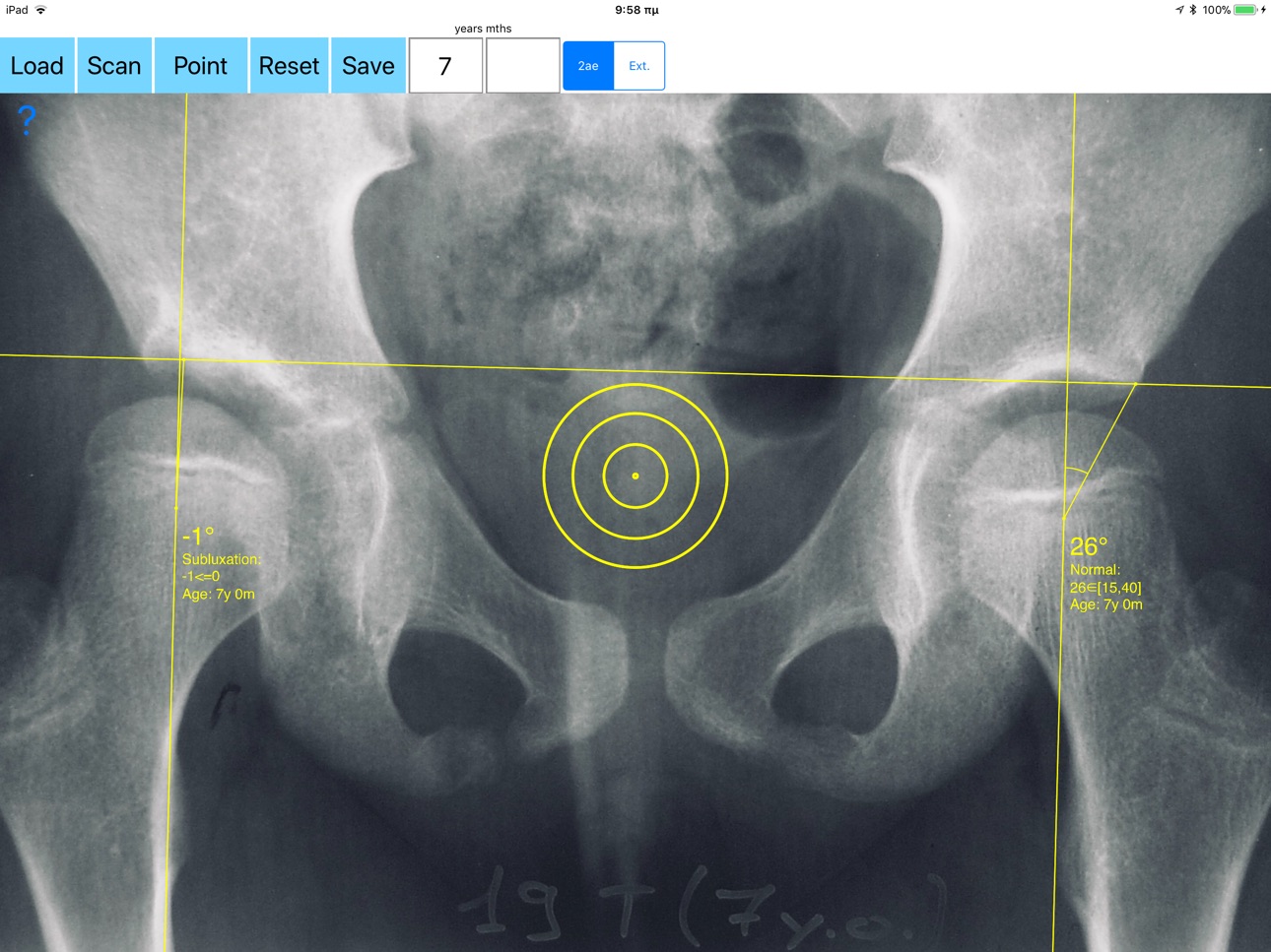 Screenshot 6 of CenterEdgeAngleApp