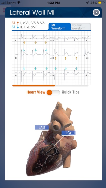 NK 12-Lead ECG Wheel