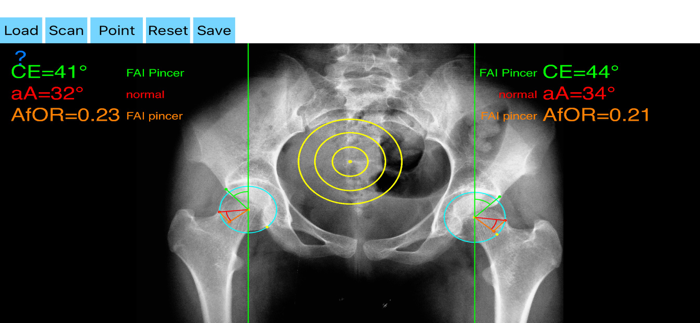 FemoroAcetabularImpingementApp