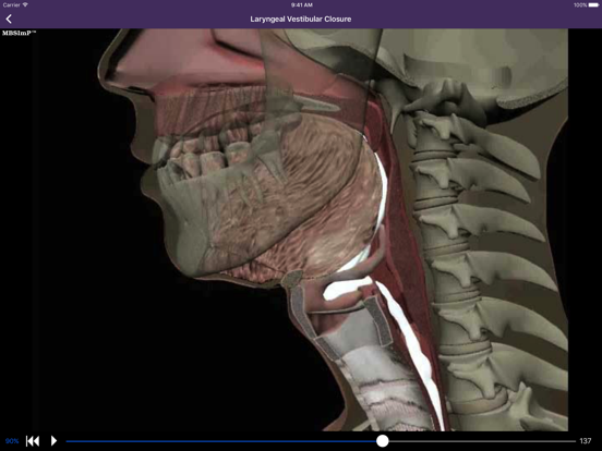 Screenshot #6 pour Dysphagia