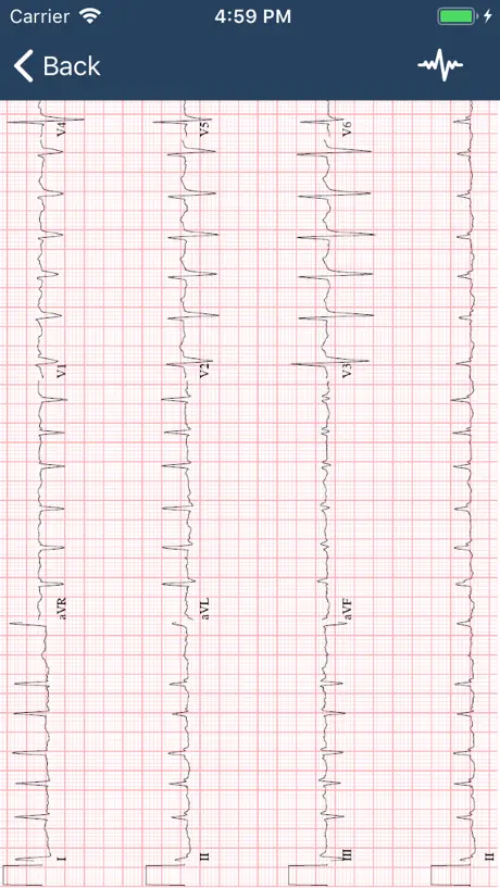 ECG Guide