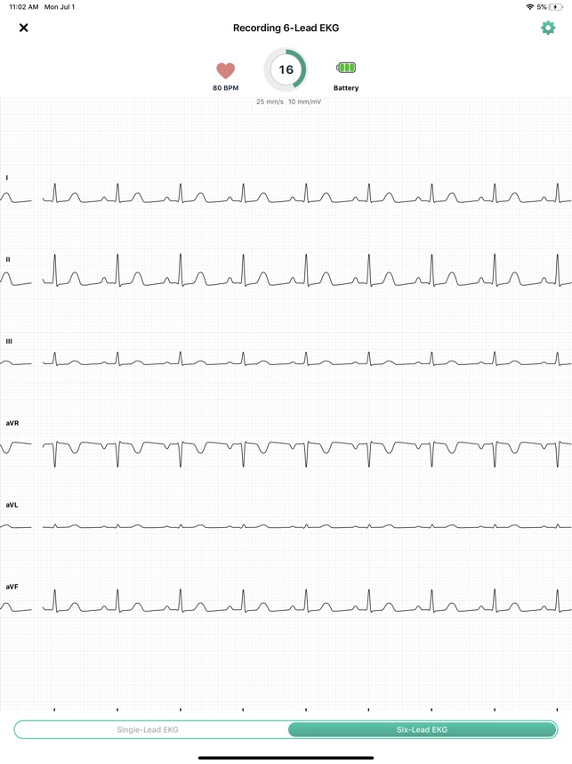 Recording obtained with the AliveCor Kardiamobile 6L device. Image used