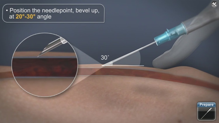 Medrills: Obtaining IV Access