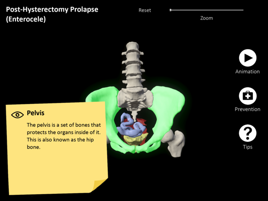 myProlapse iPad screenshot 1 - Medical app