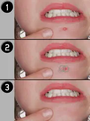 pimple eraser ipad resimleri 4