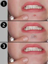 Pimple Eraser ipad bilder 3