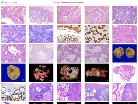 Ovarian Tumor Pathologyのおすすめ画像2