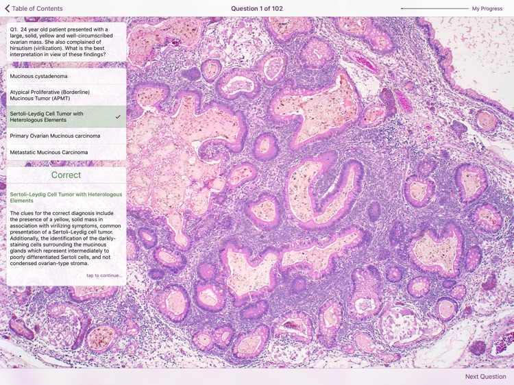 Ovarian Tumor Pathology screenshot-4