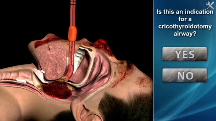 Medrills - Cricothyroidotomy screenshot-3