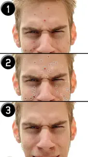pimple eraser iphone resimleri 1
