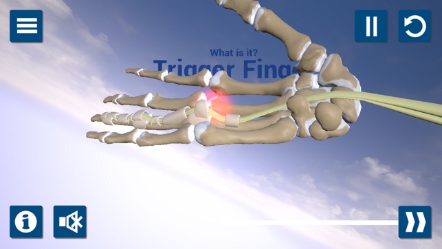 Trigger Finger 3D