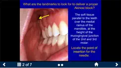 Dental Anesthesia-SecondLook iPhone image 3