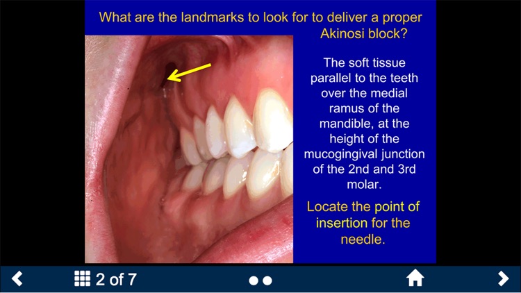 Dental Anesthesia-SecondLook