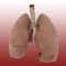 Non-small-cell lung cancer (NSCLC) is 1 of 2 main types of lung cancer