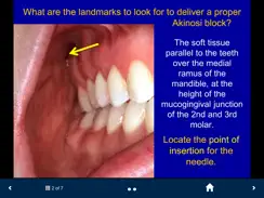 Dental Anesthesia-SecondLook iPad image 3