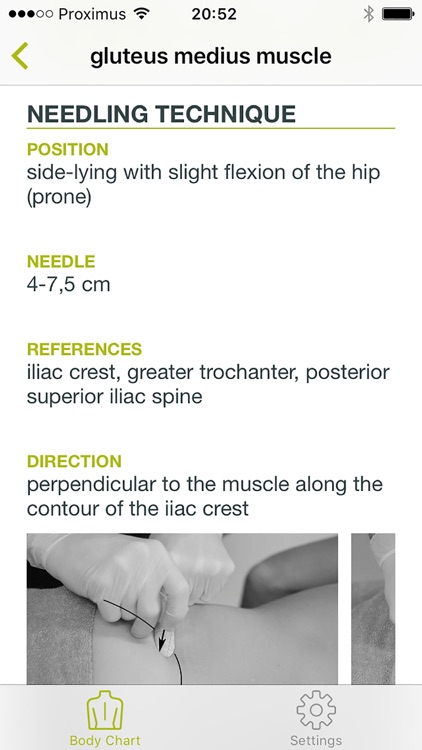 Dry Needling Guide
