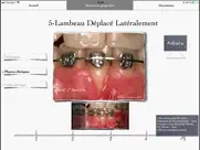 imuco récessions gingivales ipad resimleri 3