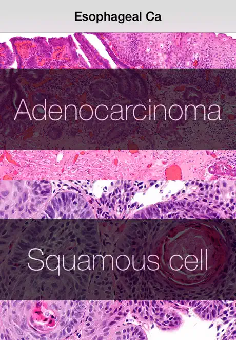 Esophageal Cancer Stage