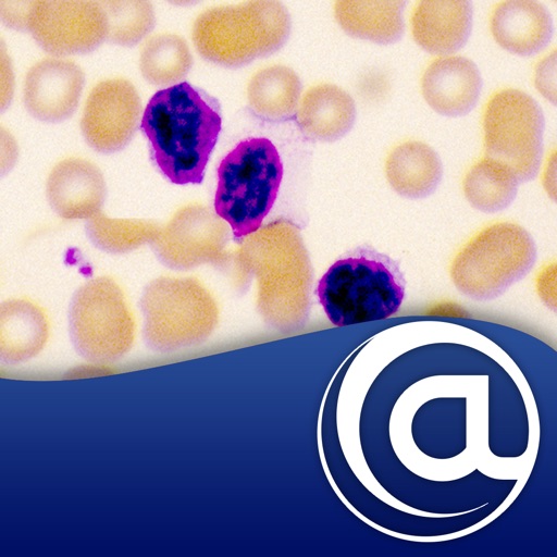 Chronic Lymphocytic Leukemia