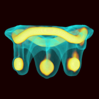 Valve In Valve Mitral