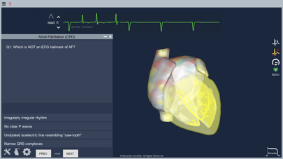 Atrial Fibrillation Screenshot