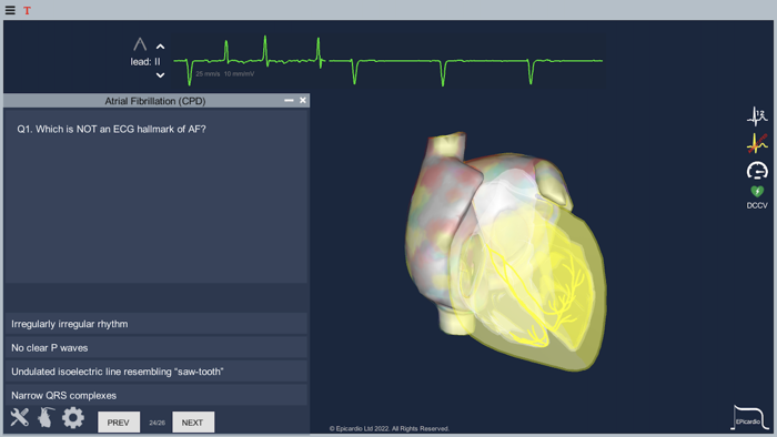 Atrial Fibrillation