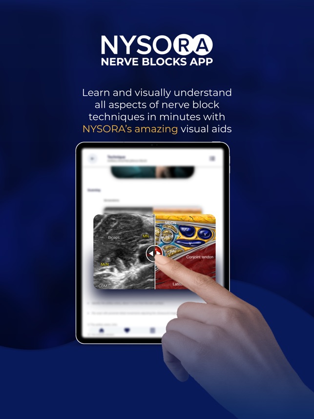 Lower Extremity Nerve Blocks Poster (in) – NYSORA