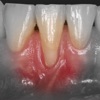 iMuco Gingival recessions icon