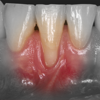 iMuco Gingival recessions - iPhormation