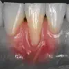 iMuco Gingival recessions delete, cancel