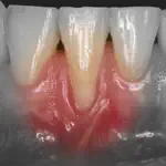 IMuco Gingival recessions App Negative Reviews