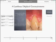 imuco récessions gingivales ipad resimleri 1