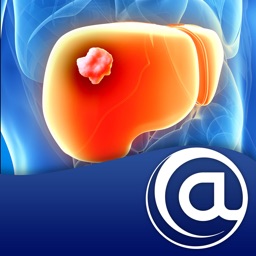 Hepatocellular Carcinoma