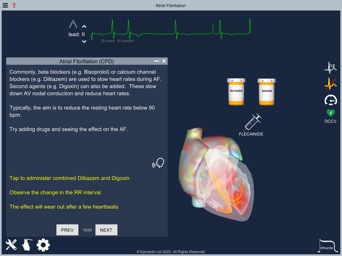 Atrial Fibrillation