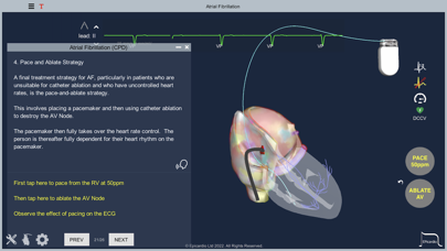 Atrial Fibrillation Screenshot