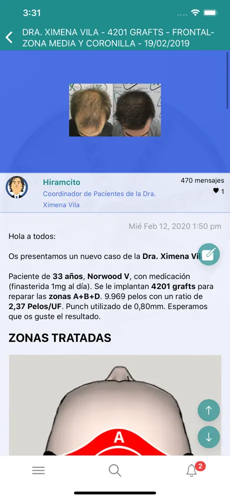 Injerto Capilar