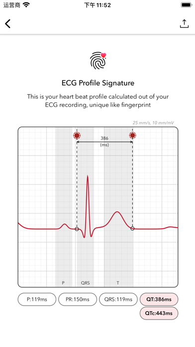 ECG+ Analyzer for QT/QTc & HRV Screenshot
