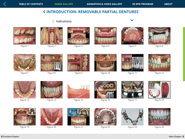 Removable Partial Dentures(圖5)-速報App