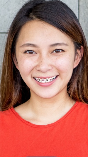 Braces on teeth – Photo editor orthodontic(圖3)-速報App