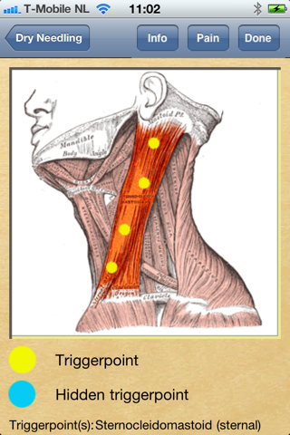 Dry Needling Therapy screenshot 3