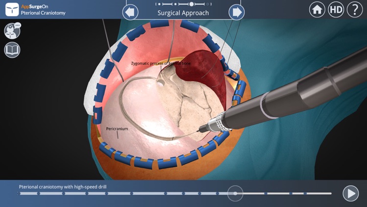 Pterional Craniotomy screenshot-4