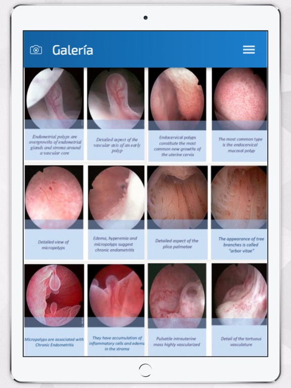 Screenshot #5 pour Hysteroscopy News